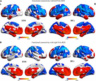 Enhanced Resting-State Functional Connectivity of the Nucleus Accumbens in First-Episode, Medication-Naïve Patients With Early Onset Schizophrenia